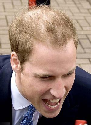 prince william hair loss. prince-william-balding