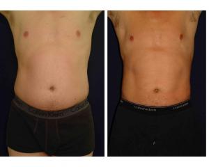 liposuction.male_.1a_full