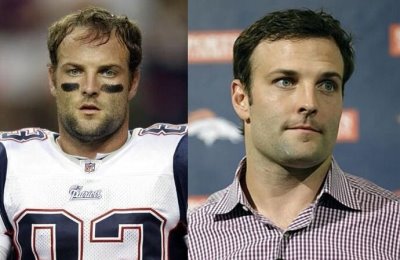 wes-welker-before-and-after-hair-surgery-with-dr-robert-leonard.jpg