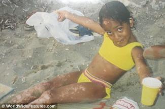 darcel de vlugt vitiligo skin - young girl