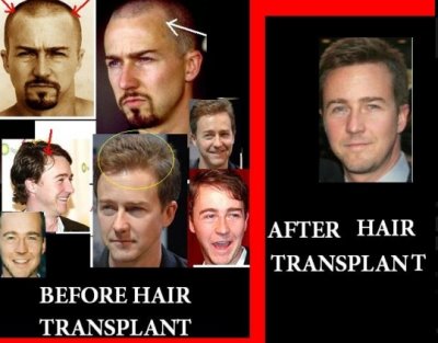 edward norton hair transplant before and after - plastic surgery star
