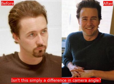 edward norton hair transplant before and after3