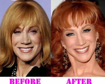 kathy griffin face lift before and after
