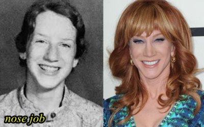 kathy griffin nose job before and after