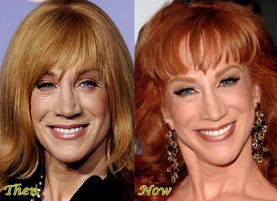 Kathy Griffin plastic surgery then and now