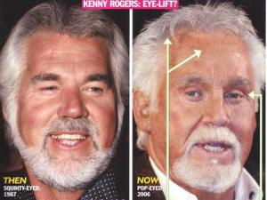 kenny rogers plastic surgery before and after