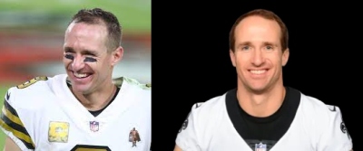 drew brees hair transplant - before and after