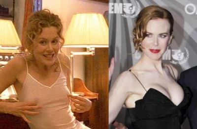 nicole kidman plastic surgery before and after