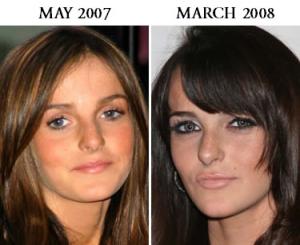 ali lohan plastic surgery before and after