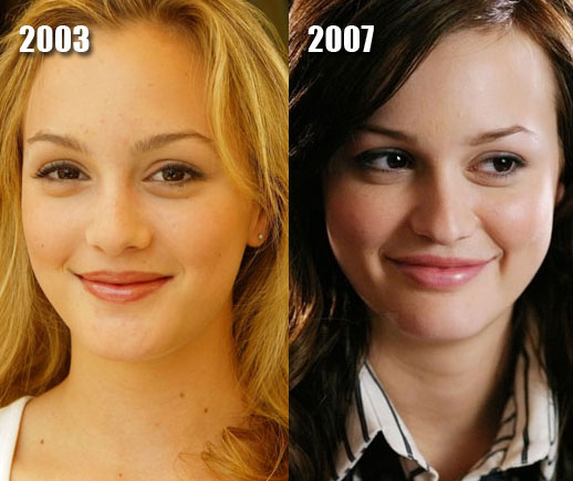 Leighton Meester Plastic Surgery: Nose Lift Before and After Pics. 