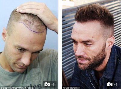 calum best hair transplant - before after second hair surgery - photos