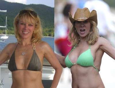 ramona singer boob job before and after