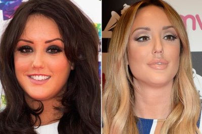 charlotte crosby plastic surgery before and after lip augmentation