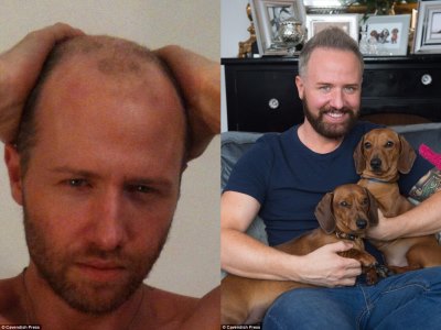 chris steed hair transplant before and after photos