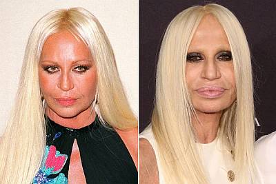 bad celebrity plastic surgery list - donatella versace gone awry