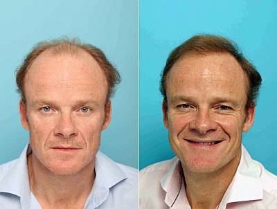 alistair petrie hair transplant before and after