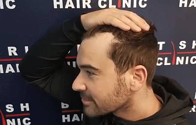 alex miller bald receding hairline